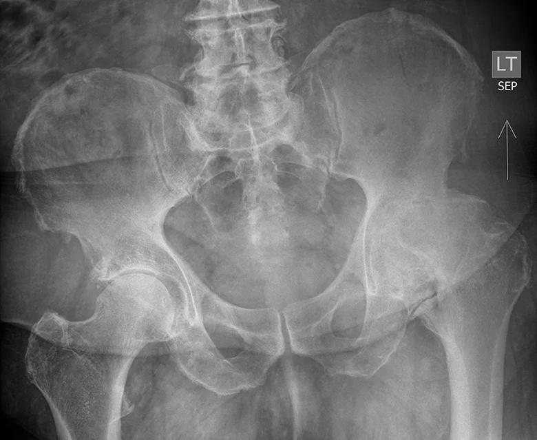 Severe left hip arthritis with ankylosis of the hip