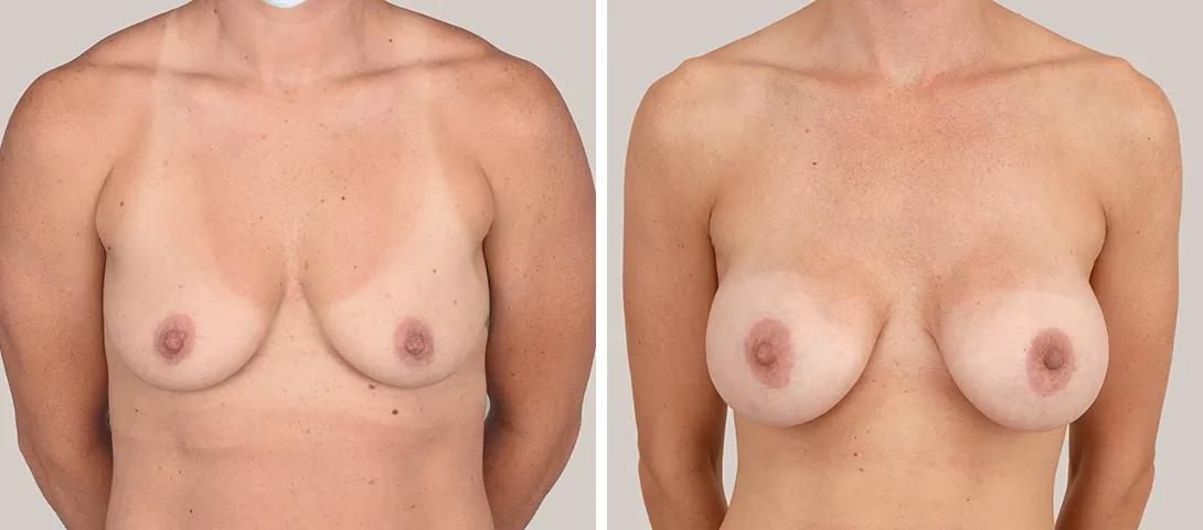 Breast augmentation before & after photo