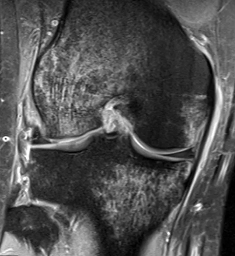 Coronal MRI showing bruising to medial tibial plateau and medial and lateral femoral condyles. 
