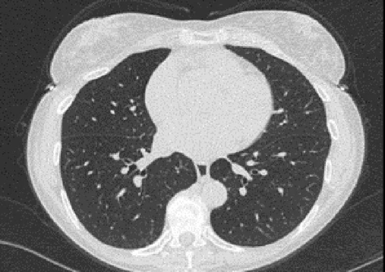 Complete resolution of CT findings can be seen at the patient’s one-year follow-up.