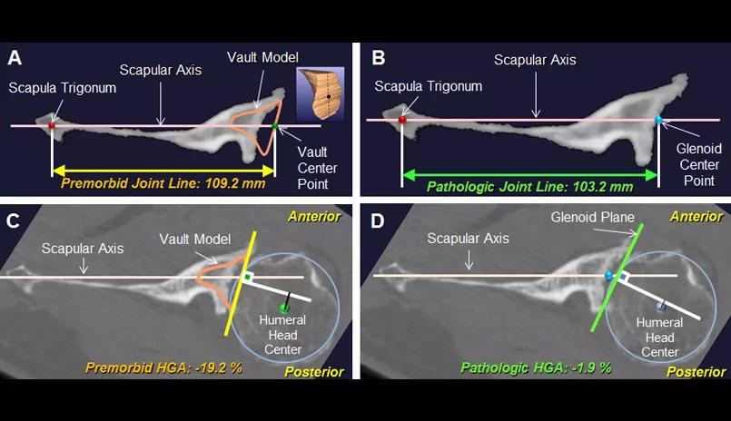 Shoulder arthritis