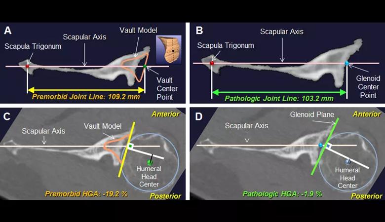 Shoulder arthritis