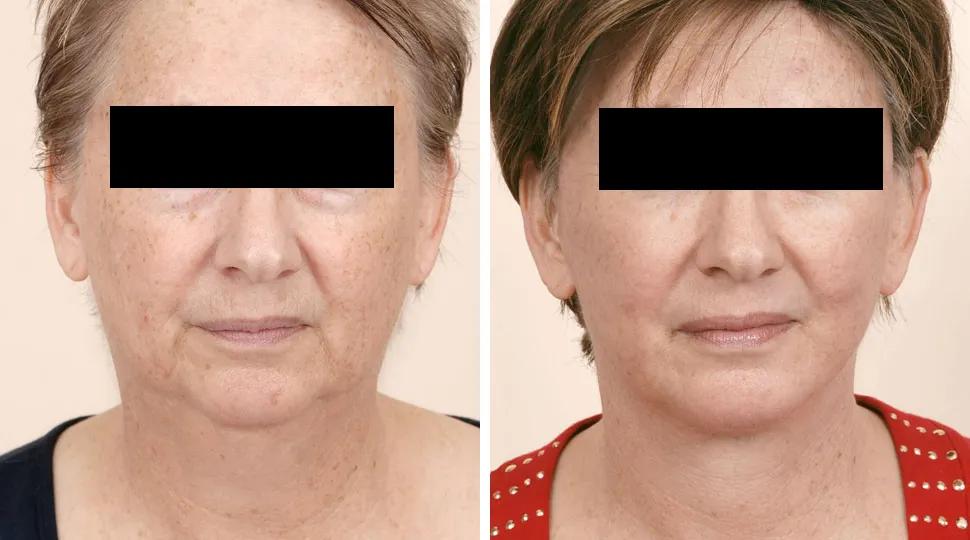 Facelift before & after photo