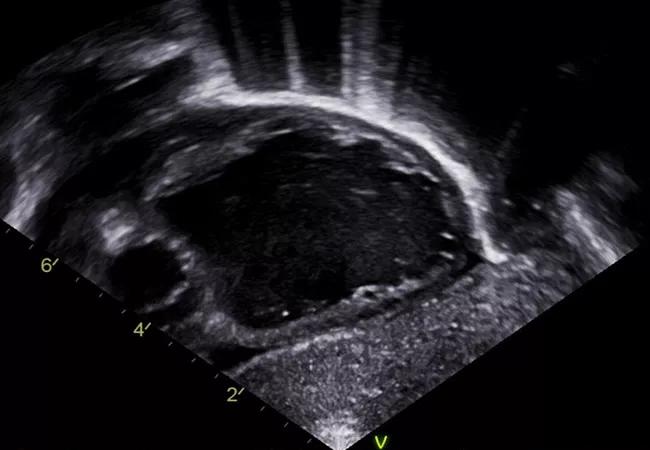 Confirmatory echo taken in the cardiac cath lab immediately after birth.