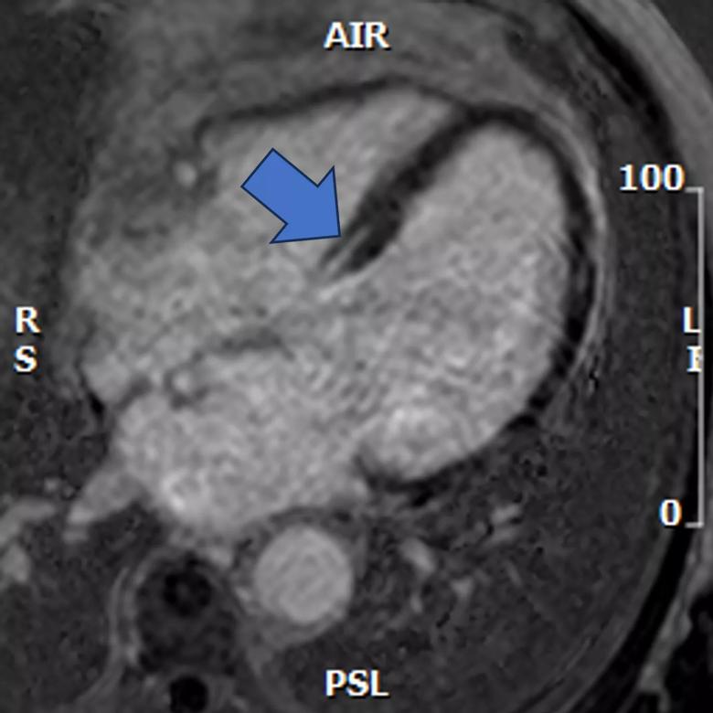 cine cardiac MRI image for phenogroup 2