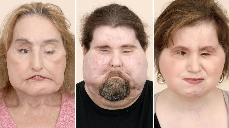 face transplant Cleveland Clinic