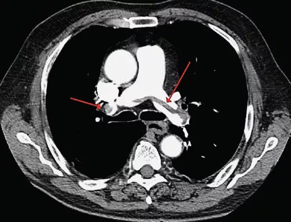 Figure 2. Chest CT showing saddle pulmonary emboli.