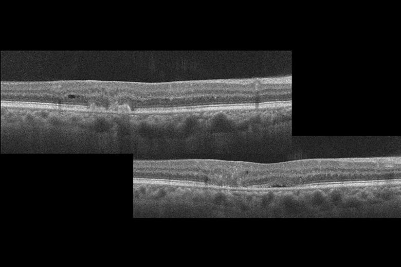 OCT rasters of a patient with idiopathic macular telangiectasia