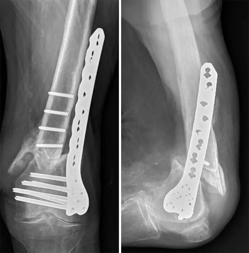Preoperative radiographs of the left distal femur demonstrating a supracondylar nonunion