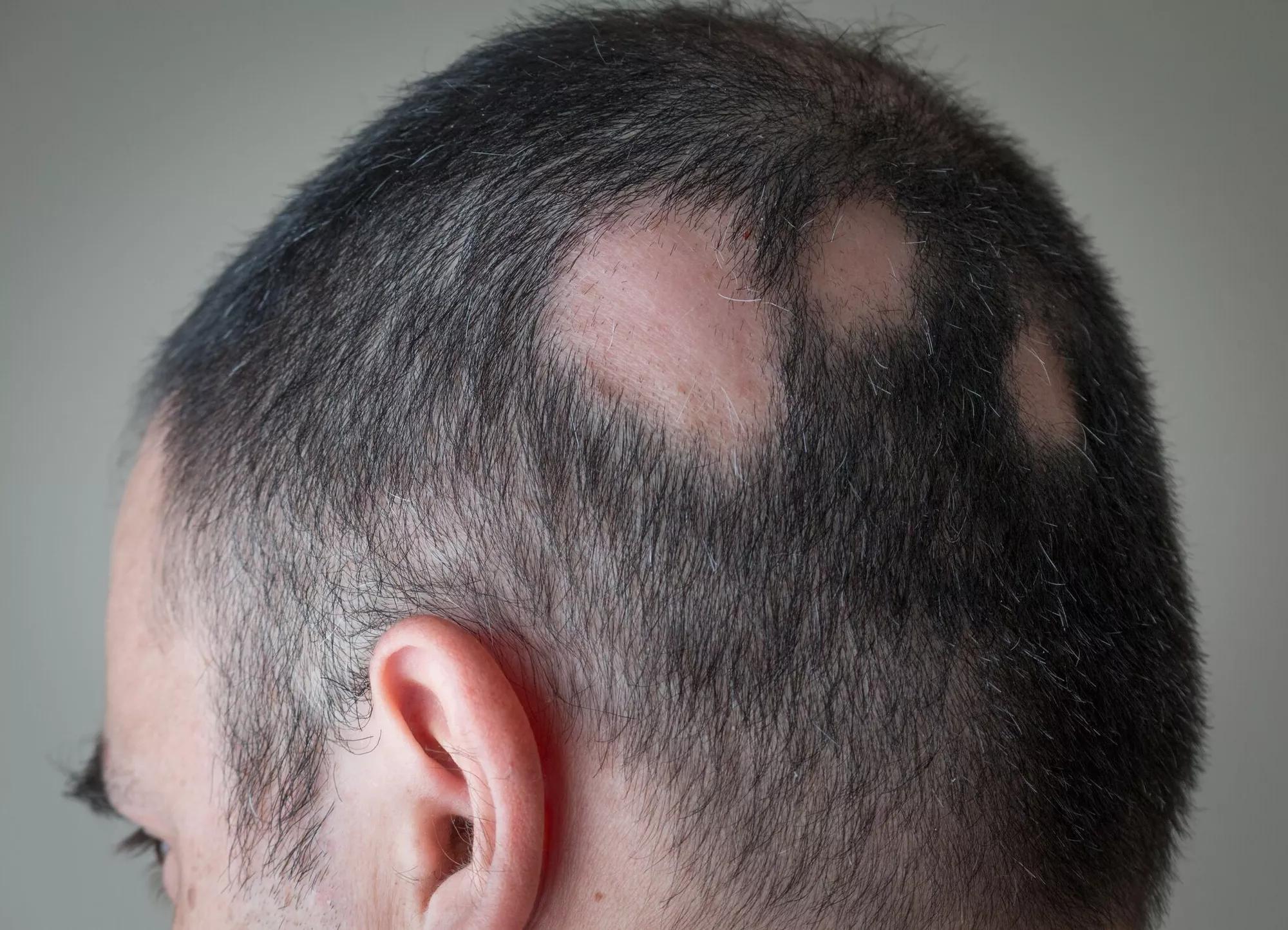 Alopecia Areata Self-Care and Stress Management