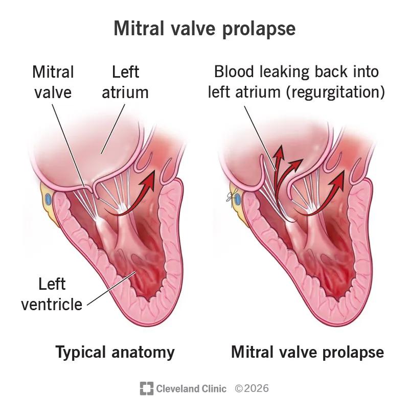 A heart with mitral valve prolapse compared to a heart without the condition