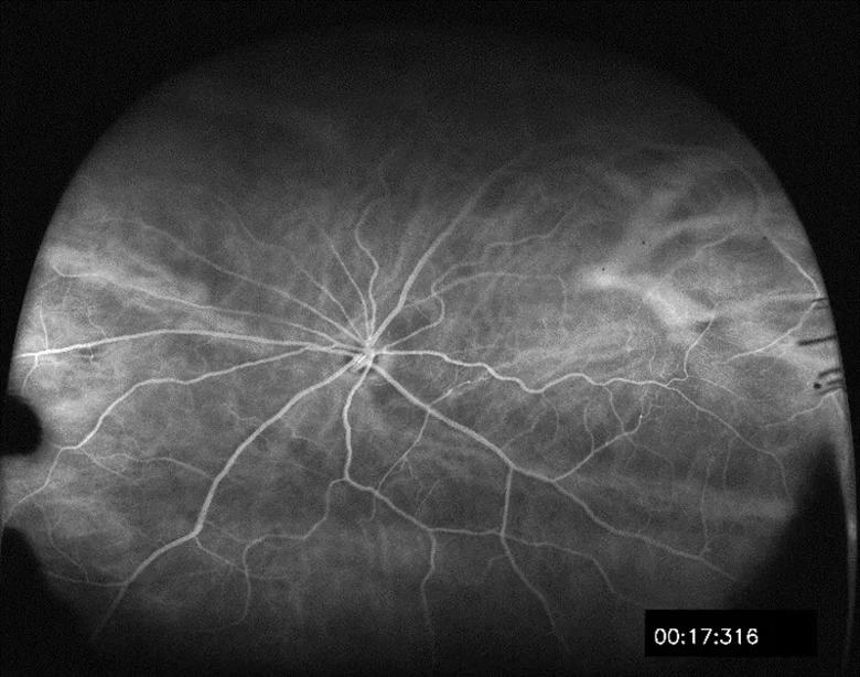 An image showing wide field fluorescein angiography used to monitor the development of radiation-induced retinopathy in a Lewis rat.