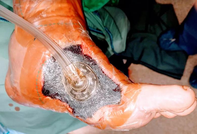 Wound therapy
