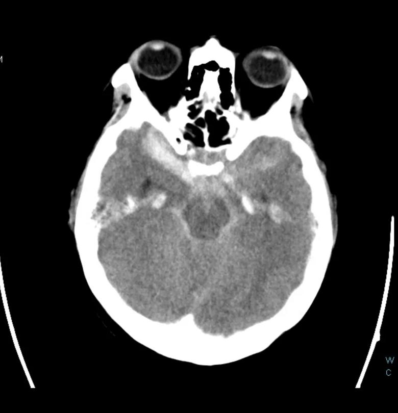 head CT scan showing subarachnoid hemorrhage