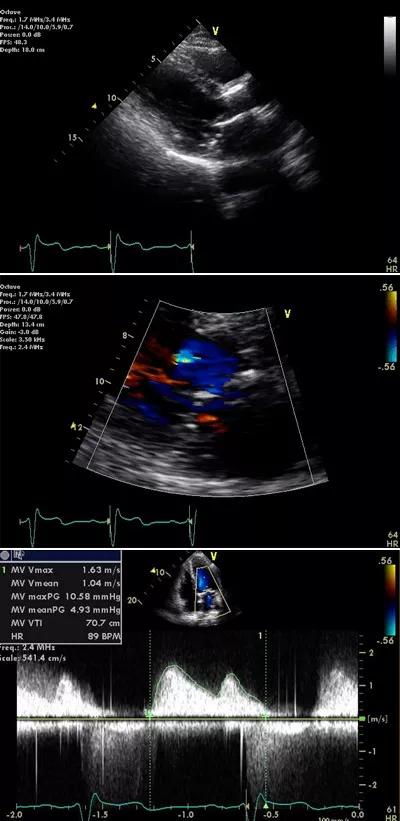 Figure 3. The patient’s echocardiography findings one year after TAVR. 