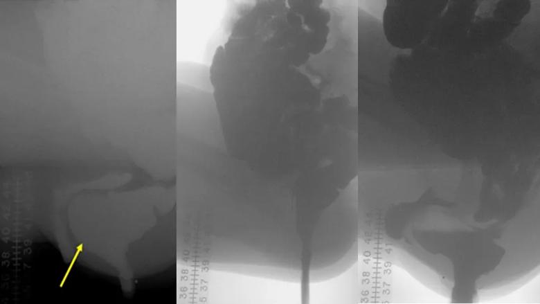 Series of Xray defecography images that illuminate how pelvic organs are functioning during defecation.