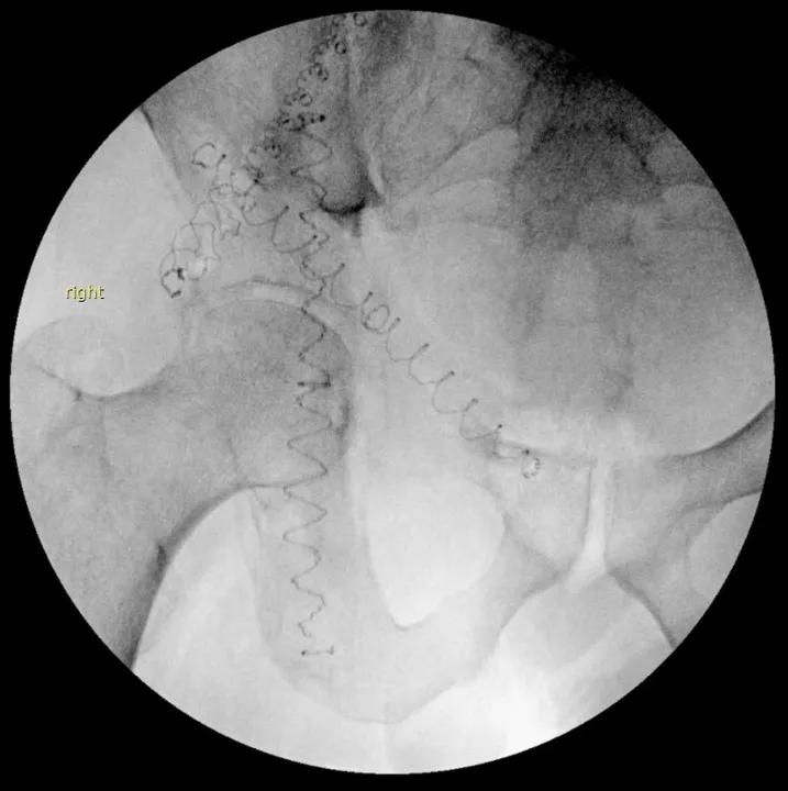 Kyphoplasty of acetabulum