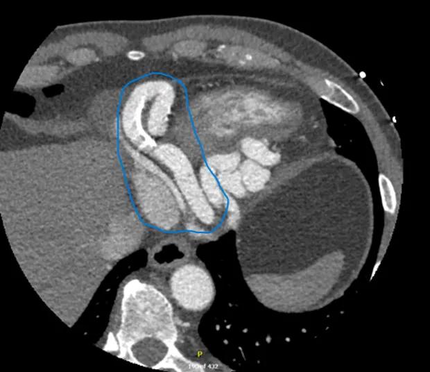 CAT scan of a heart with a blue circled area