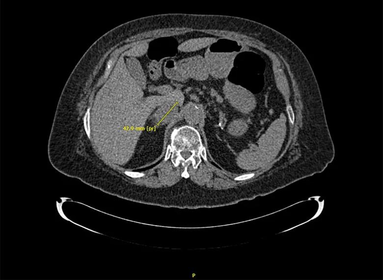 Scan image of patient's tumor