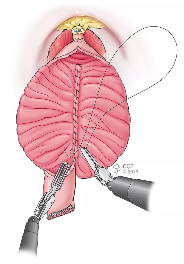 Inset-3-robotic-neo-bladder_posterior-construction-5-68824