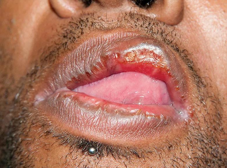 Ulcerated plaque on the upper lip.