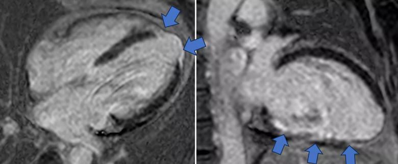 cine cardiac MRI image for phenogroup 1