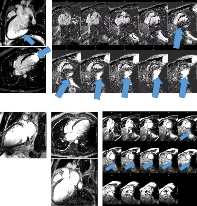 late gadolinium enhancement imaging