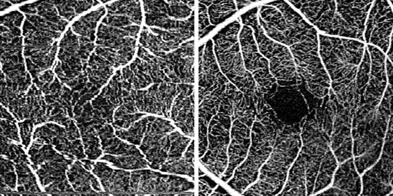 Blood vessels in macula of adult with preterm birth versus full-term birth