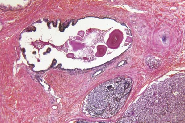 Prostate Gland Adenocarcinoma