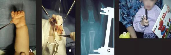 Figure 1. (A) A very hypoplastic (grade 3B) thumb that might even be termed a pouce flottant is seen in a newborn whose parents were told the only option was amputation and pollicization of the index finger. (B) Two free toe phalanges are transferred to provide supportive bone stock. (C) The distraction lengthening apparatus has been applied to lengthen the thumb to satisfactory length and alignment in an opposed position. (D) During the lengthening procedure, the child is already learning to use his thumb in a prehensile manner. (See Figure 3 for follow-up images of this patient.)