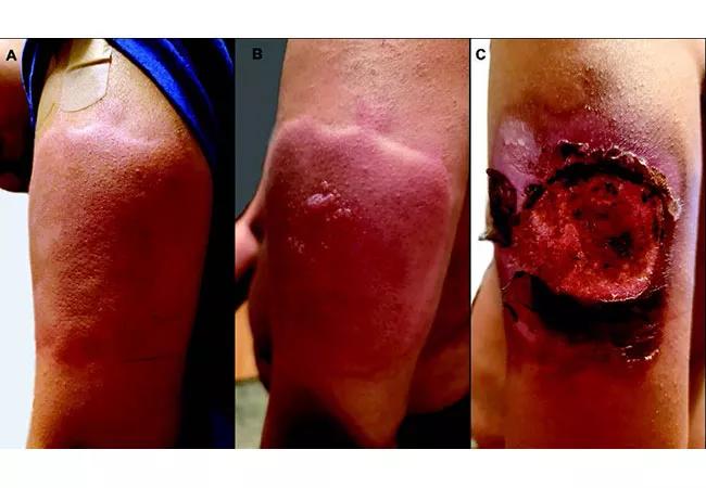 Skin infection