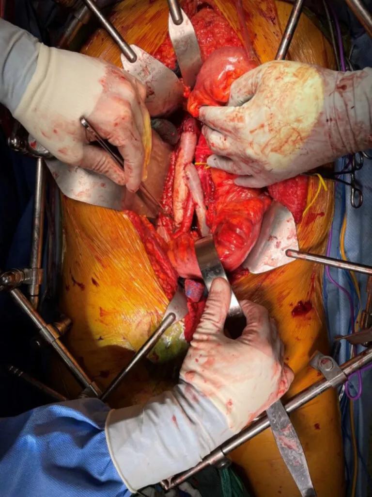 gloved surgeon hands operating on a cut-open human torso