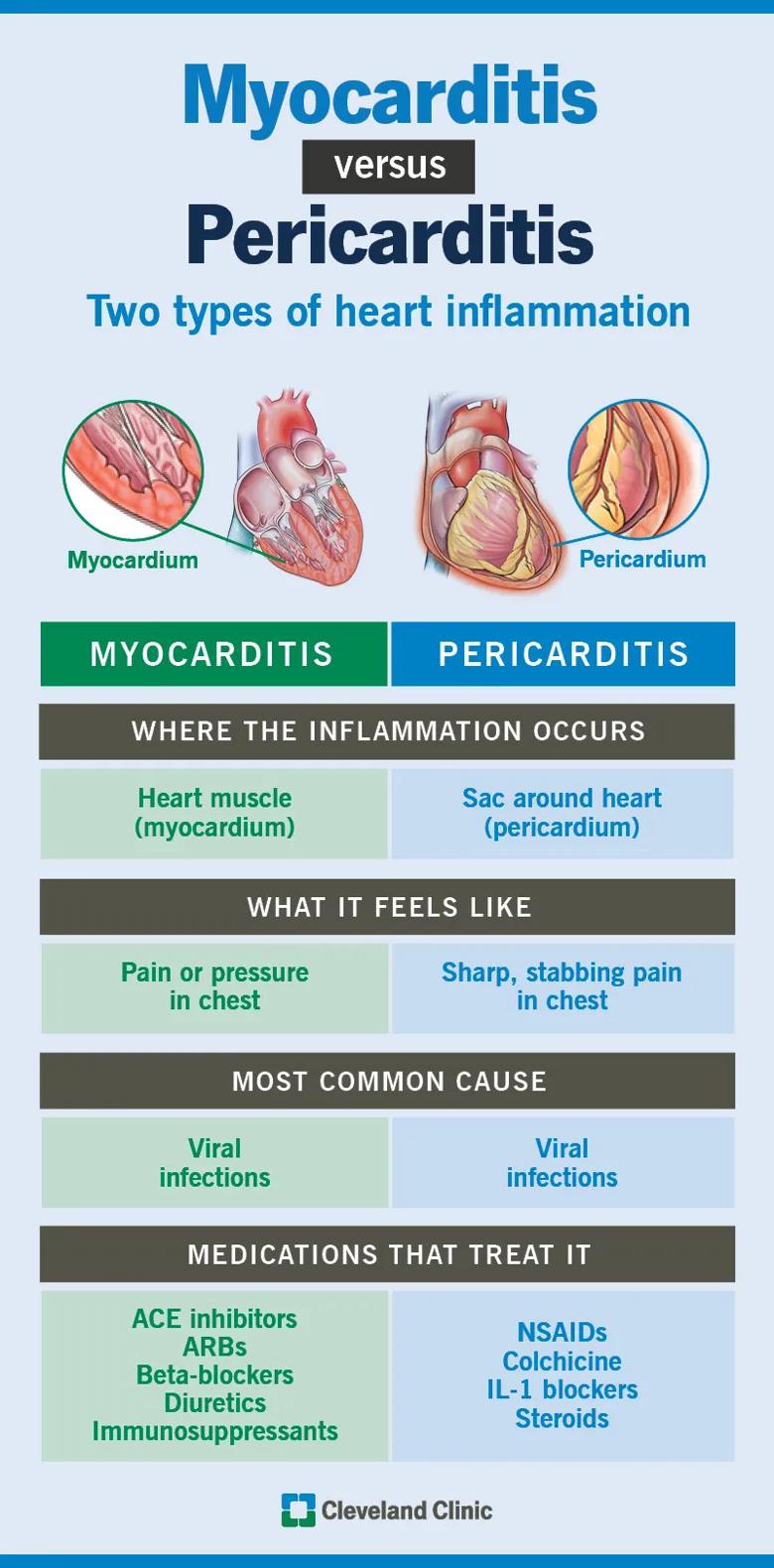 The differences between the two types of heart inflammation: myocarditis and pericarditis