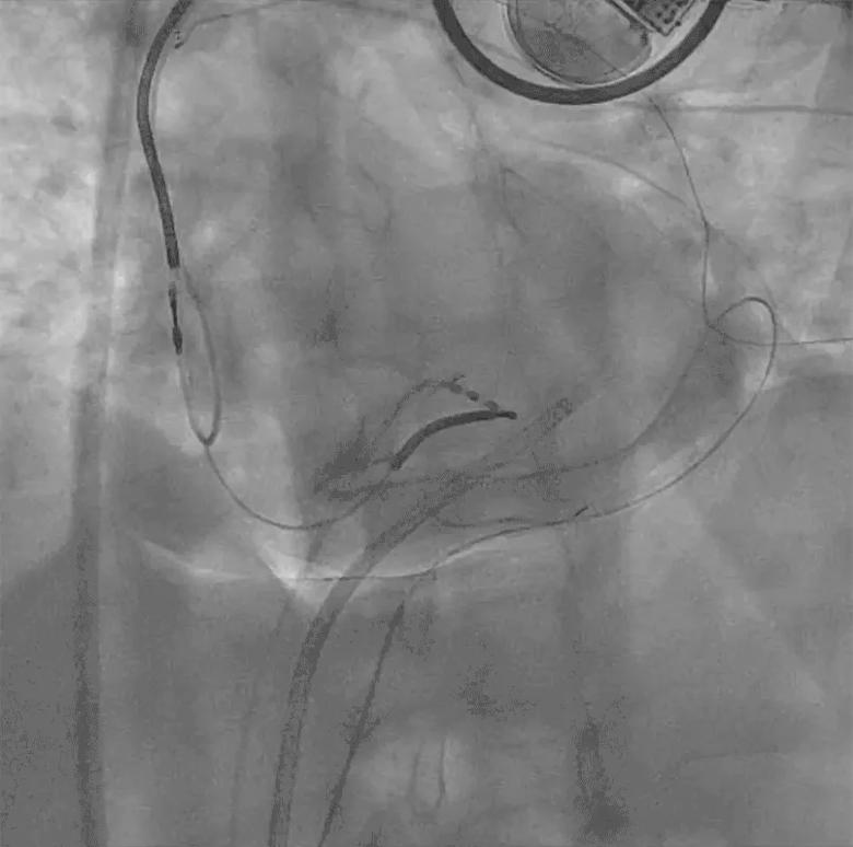 Video showing epicardial access targeting the area of largest pericardial separation on fluoroscopy