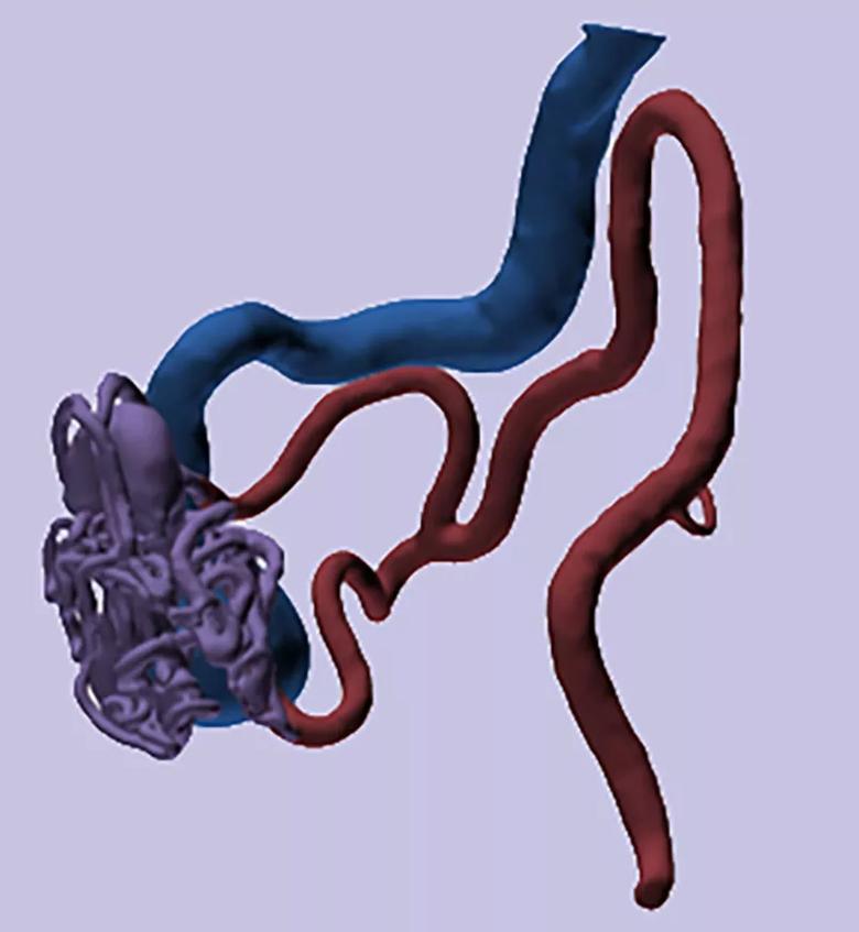 Fistereolithography rendering of a simple AVM 3D-printed flow model.