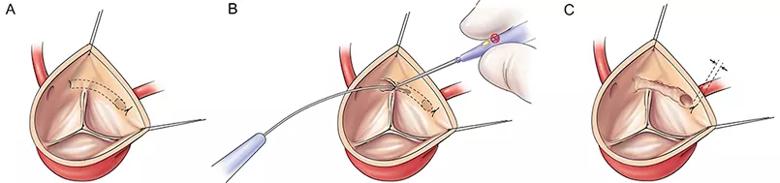 electrical fulguration technique for coronary unroofing for AAOCA.