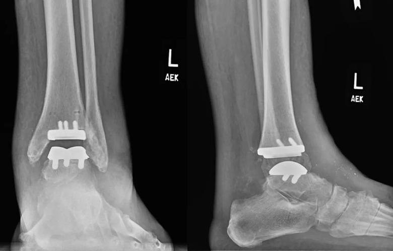 Nonstemmed total ankle replacement