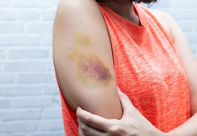 When a Bruise is More Than a Bruise