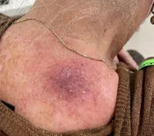 Skin cancer lesion 