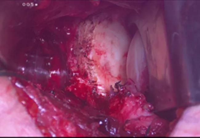 Intraoperative imaging showing anterior glenoid defect