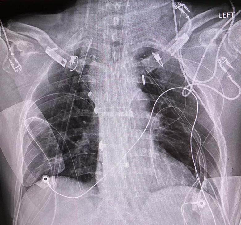 X-ray of the chest showing the ribs and sternum