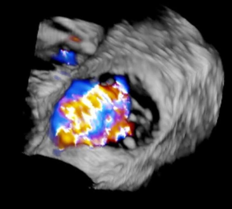 Tricuspid valve with severe regurgitation