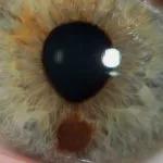 Eye-Melanoma