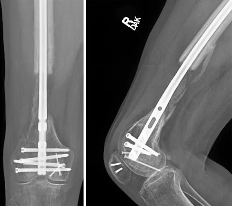 X-ray of right femur with retrograde femoral nail 