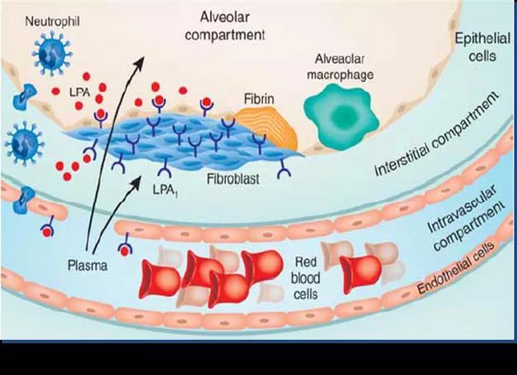 comparing the effects of the orally administered LPA1 receptor antagonist BMS-986020 vs. placebo on FVC decline in patients with IPF