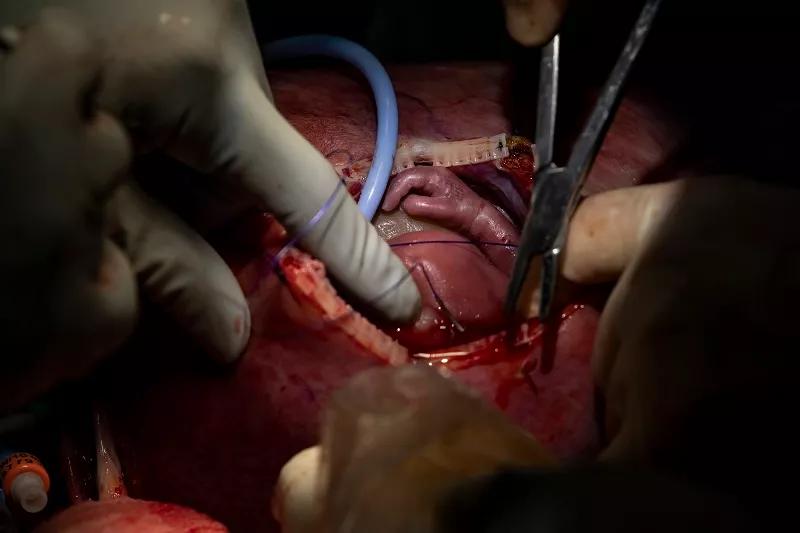 The fetus is reinternalized.