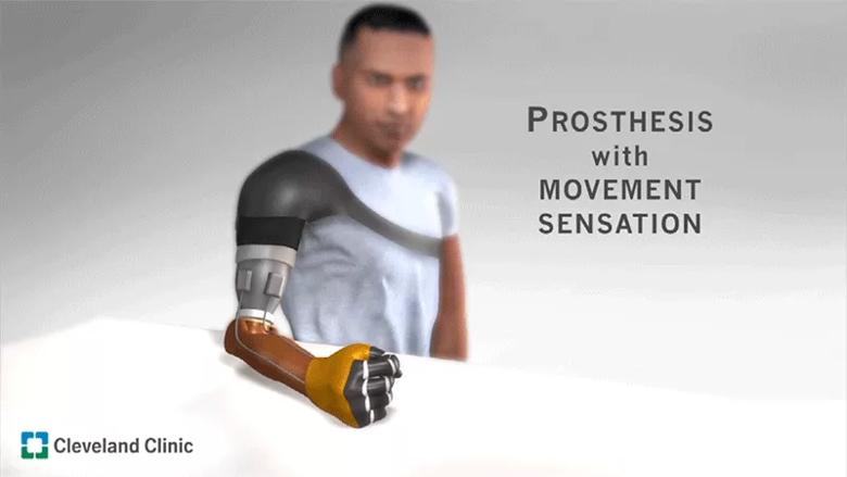 Cleveland Clinic researchers restore movement sensation in patients with prosthetic arms. 