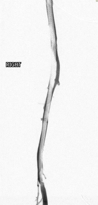 stent graft in a leg vein in an endovascular procedure