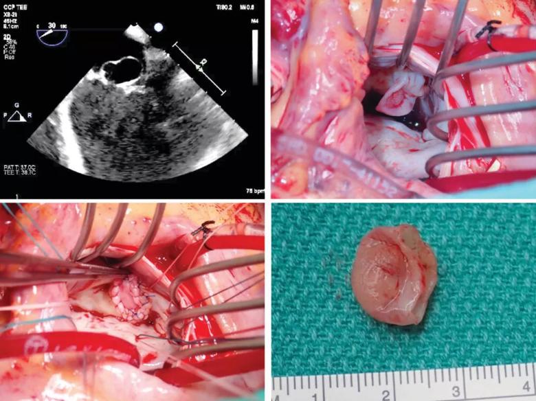 repair of windsock lesion in mitral valve infective endocarditis
