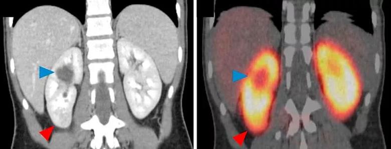 Coronal contrast-enhanced computed tomography demonstrating a 2.8-cm, solid renal mass in the lower pole of the right kidney.